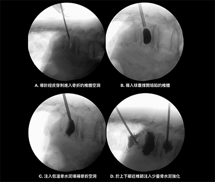 經皮椎體成形術