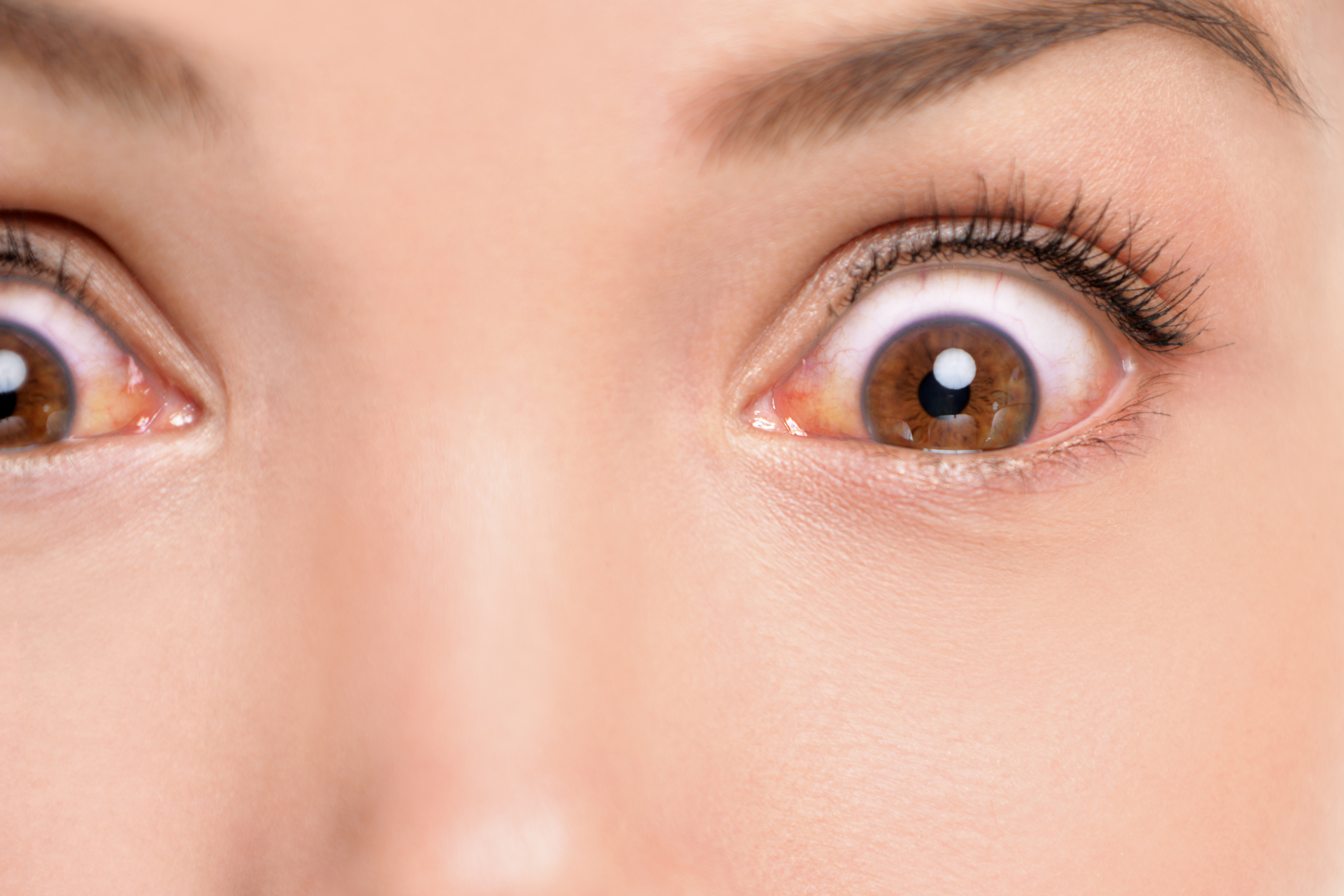 眼睛紅自我檢測三招 透視疾病 文章專區 常春月刊 全宇宙最實用的保健知識