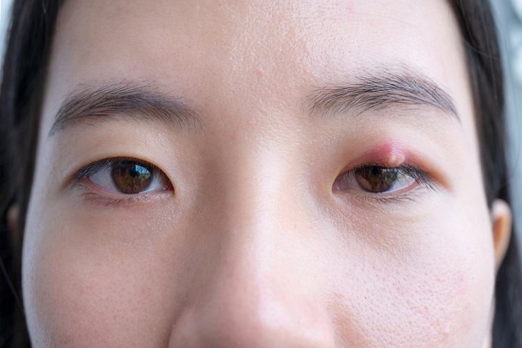 長針眼會傳染？拉眼尾有效嗎？ 眼科名醫告訴你正確答案