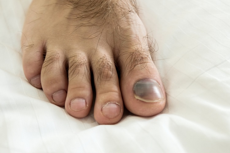 腳指甲變黑是癌上身？ 醫揭4個可能原因要提防