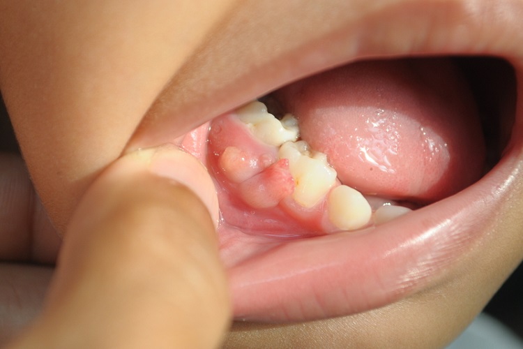 牙齦腫