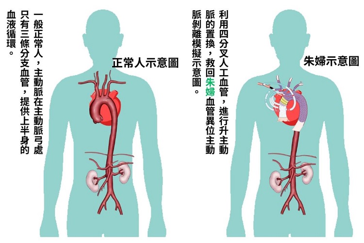 近7旬婦人胸痛、盜汗長達20分鐘，心臟血管還比別人多一條，心臟外科醫透過1招撿回一條命_圖2