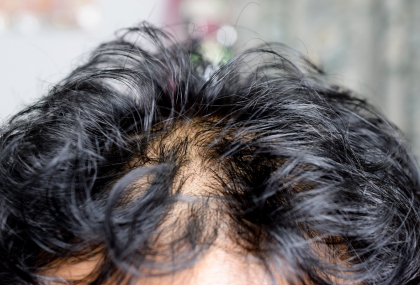 不用植髮！台大團隊研究「20天生髮液」讓頭髮長回來  成果登國際期刊